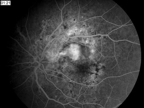 CNV secondary to Angioid Streaks, PXE
Schlüsselwörter: Angioid Streaks, PXE, CNV