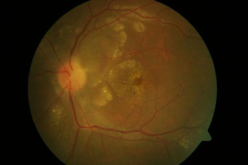 A case of Disc Granuloma-2
