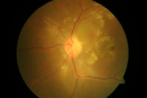 A case of Disc Granuloma
