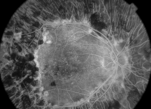 early phase FA
50+ YO female presented with DM type 1;
PT presented with PDR s/p extensive PRP
FA showed CNV OD
VA stable at 20/150 for 1 year

Keywords: cnvm;cystoid macular edema;Diabetic;diabetic like;laser