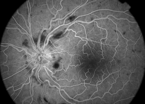 early phase (40 sec) fa of a 27 year old male with crvo os VA 20/20
Keywords: crvo