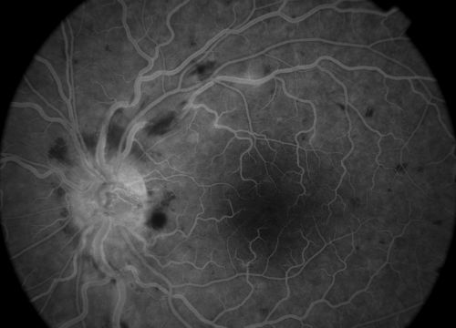 CVO
mid phase (3min) fa of a 27 year old male with crvo os VA 20/20
Keywords: crvo