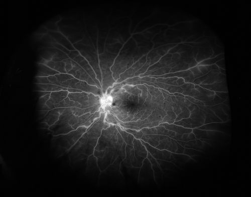 CVO
late FA (5min) optos photo of a 27 year old male with crvo os VA 20/20-
Keywords: crvo