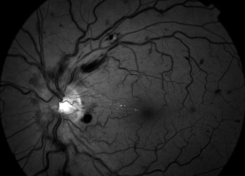 red free of a 27 year old male with crvo os VA 20/20
Keywords: crvo
