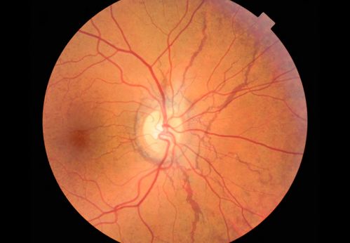 ANGIOID STREAKS
A 29 year old woman was referred to the ophthalmologist for an eye exam since the dermatologist had noted â€œchicken-skinâ€ papules in the neck skin. PAD showed for pseudoxathoma elasticum typical pathology. The eye exam disclosed angioid streaks, asymptomatic so far.

Magnus GjÃ¶tterberg MD
International membrer 1440
S:t Erik Eye Hospital
SE-11282
Stockholm
Sweden
magnusgjotterberg@hem.utfors.se
magnus.gjotterberg@sankterik.se.

Photographer/technician
Malin Langhals

Keywords: mar2012