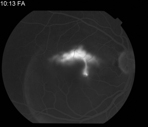 Classic Smoke Stack
32 yrs old male Presents: with blurry vision x 10 day's visual acuity OD CF@5ft, Note  Observation was recommended. Patient return 10/ 2013 with visual improvement of 20/30 and on 11/2013  VA 20/25 stable.
Keywords: January2014