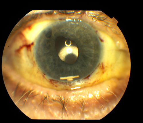 Ozurdex Implant in AC
79yr old male presents Blurry vision with slight discomfort x 1 week in OD . Pt is S/P Ozurdex Implant x 2mos which is now surfaced in the Anterior Chamber.
Keywords: Anterior Chamber