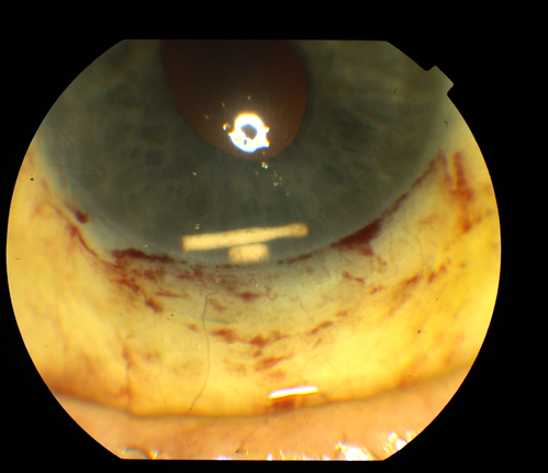 Ozurdex Implant in AC
79 yr old male presents with Blurry vison with slight discomfort x 1 in OD. Pt is S/P Ozurdex Implant x 2 mos which has now surfaced in the Anterior Chamber. 
Keywords: march2013