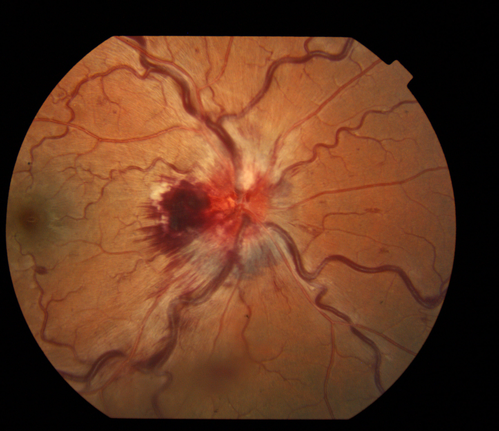 Central Retinal Vein Occlusion - Severe Optic Nerve Edema
15 yr old male presents with sudden onset of painless decreased vision in right eye x 6 days gradually worsening. No history of Trauma OD 20/30 OS 20/25, Diagnosis CRVO  with ? Papillophlebitis.
Keywords: november2012