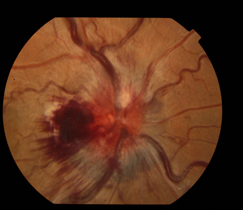 15 yrs old male presents with sudden onset of painless decreased vision in right eye x 6 days gradually worsening. No history of Trauma OD 20/30 OS 20/25, Diagnosis CRVO with ? Papilophlebitis
