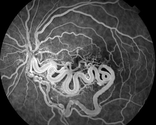 Wyburn Mason Syndrome
28 year old female, visual acuity OS 20/200
Keywords: feb2012