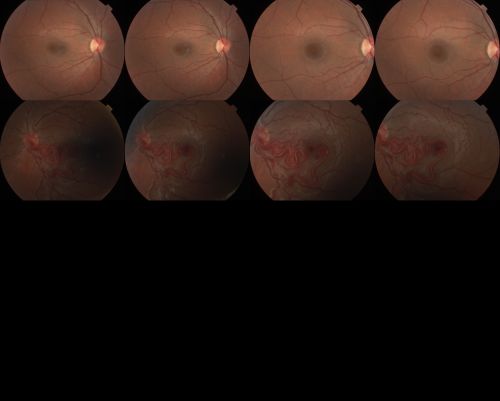 wyburn-mason syndrome fundus photos
28 year old female, visual acuity 20/200
