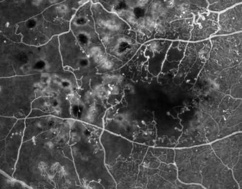 Capillary Drop Out of the FAZ
High magnification image of a damaged foveal avascular zone secondary to proliferative diabetic retinopathy. Seen here are multiple laser scars and capillary drop out in FAZ.
Keywords: FAZ;diabetic retinopathy;capillary drop out