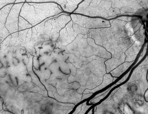 Capillary Pruning
Capillary drop out secondary to proliferative diabetic retinopathy
Keywords: Diabetic Retinopathy, capillary drop out, pruning, vessel abnormality