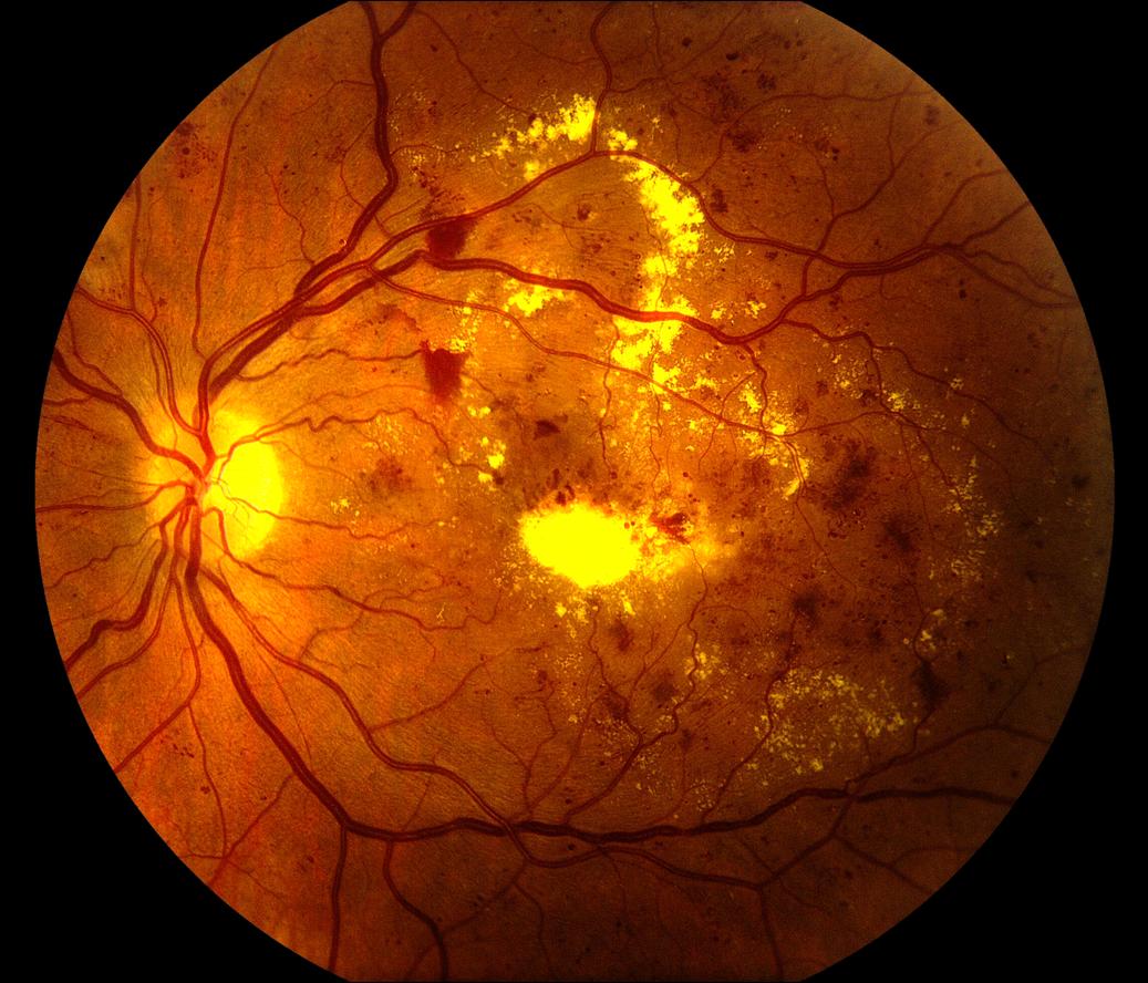 Гипертоническая ангиопатия обоих глаз. Атеросклеротическая ретинопатия. Диабетическая ретинопатия сетчатки глаза. Ишемическая ретинопатия.