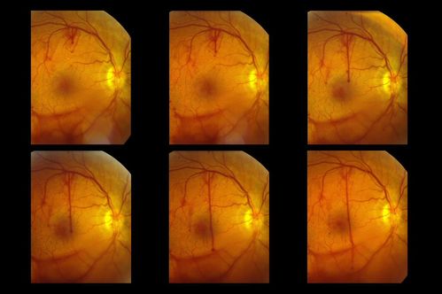 Actively Bleeding NVE
This male patient was referred for a diabetic examination.  Upon dilated exam, he started to hemorrhage from a frond of NVE in the superior arcade. These six photographs follow the flow of the hemorrhage through the vitreous to the inferior arcade.
Keywords: Diabetic;hemorrhage;NVE;vitreal;arcade