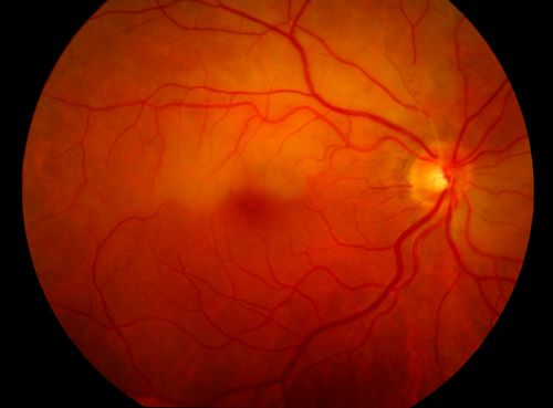 Branch Retinal Artery Occlusion with Hollenhorst Plaques
Branch Retinal Artery Occlusion with Hollenhorst Plaques
Keywords: Branch, Retinal, Artery, Occlusion, Hollenhorst, Plaque