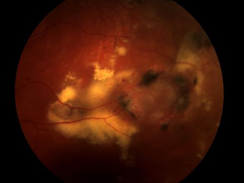 Choroiditis
CHOROIDITIS:  This 46 year old female patient was found to have a peripheral sector of old chorioretinal inflammation accompanied by low grade oozing, intraretinal telangietatic vessels and hard exudates.  There was no active bleeding or overlying vitritis.
Keywords: Choroid;choroiditis;inflammation;hemorrhage;telangietatic;vitritis
