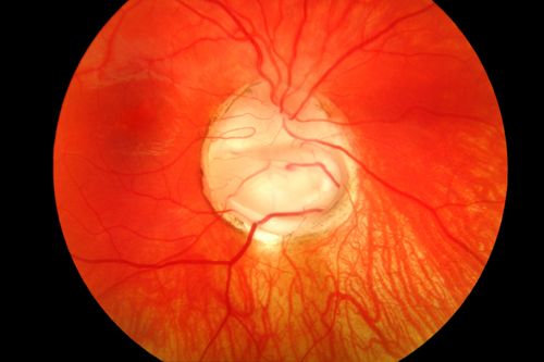 Coloboma of the optic Nerve
Coloboma
James L. Perron
Keywords: Coloboma, Optic, Nerve, Disc, Abnormality