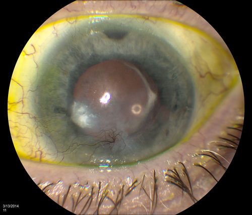 Corneal Neovascularization
Keywords: Neovascularization;Cornea