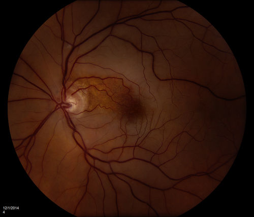 CRAO WITH SPARING OF CILIORETINAL ARTERY
This patient was found to have retinal edema from a Central Retinal Artery Occlusion with sparing of the cilioretinal artery.  There were no discernible Hollenhorst plaques 
Keywords: Central;Retinal;Artery;Occlusion;Hollenhorst;plaque;CRAO;cilioretinal;edema;sparing