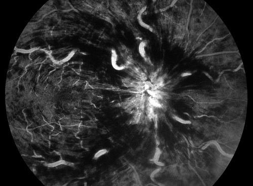 Central Retinal Venous Occlusion with Papilledema, Irtraretinal Hemorrhage and Vascular Tortuosity
Keywords: CRVO, Central, Retinal, Venous, Vein, Occlusion, Intraretinal, Tortuosity, october2013