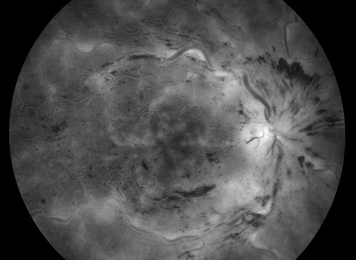 Central Retinal Venous Occlusion with Papilledema, Intraretinal Hemorrhage and Macular Edema
Keywords: Central Retinal Venous Occlusion;CRVO, Papilledema;Intraretinal Hemorrhage;Macular Edema;december2013