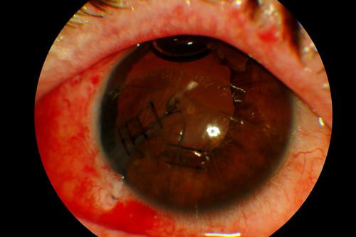Corneal Sutures after Trauma
James L. Perron, C.R.A.
Keywords: Trauma, Cornea, Suture, Repair