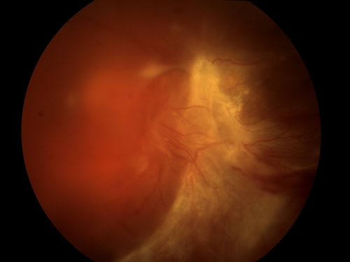 Diabetic Tractional Detachment
Keywords: Diabetic;tractional;traction;detachment