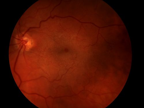 ERM with Pseudohole
Schlüsselwörter: ERM;Epiretinal membrane;pseudohole;wrinkling retinopathy;cellophane retinopathy;december2013