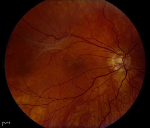 ERM
ERM: Epiretinal Membrane	
Five years prior to presentation this patient was struck in the eye with a basketball, suffering a vitreal hemorrhage.  He underwent vitrectomy and cataract surgery.  He later developed a faint ERM.   On recent presentation he complained of increased blurring and a floater in his O.D. Examination determined that the ERM had become more prominent.

Keywords: ERM;epiretinal;membrane;wrinkling;cellophane;retinopathy;retinal;macular pucker