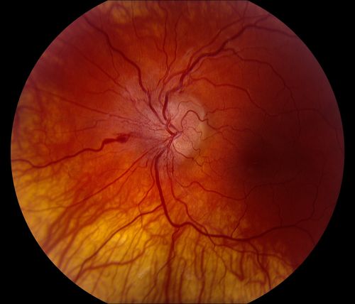 Idiopathic Intracranial Hypertension O.S.
Võtmesõnad: Intra;Cranial;hypertension;March 2014