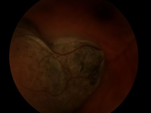 Melanoma
Keywords: Melanoma, choroidal, cancer,may2013