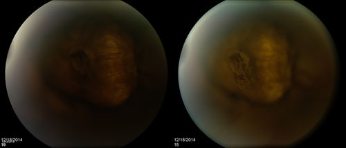 CHOROIDAL MELANOMA Stereo Pair
This patient was seen approximately five years ago with a suspicious choroidal nodule.  The patient did not return for scheduled follow up appointments.  When referred back to the practice, the nodule had erupted through Bruchsâ€™ membrane to assume a brawny mushroom cloud configuration which is visible when the stereo images are merged.
Keywords: Bruchs;melanoma;choroidal;cancer;stereo;pair;December 2014;mushroom;brawny