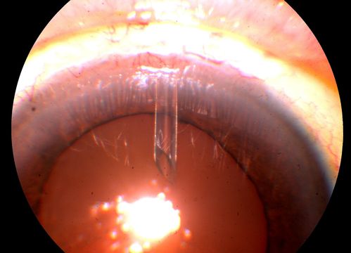 Molteno Drainage Tube
Keywords: Molteno;drainage;tube;January2014