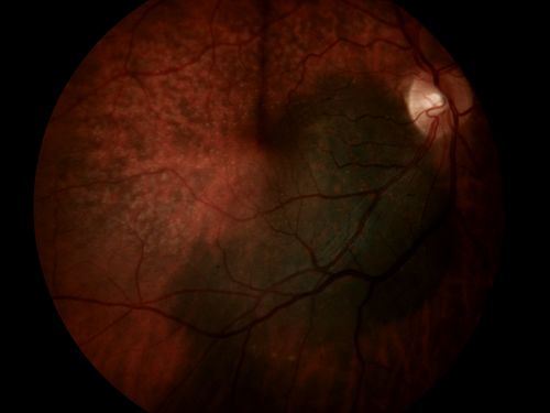 Nevus - Large - Color Photo
Nevus
James L. Perron, C.R.A.
Keywords: Nevus