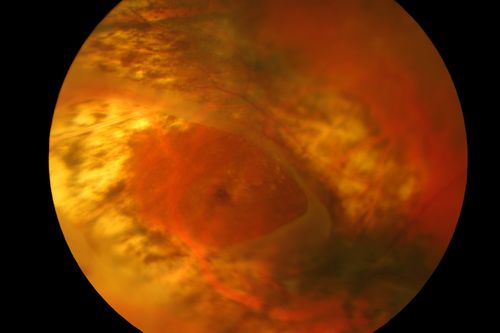 Retinal Tear
Keywords: Retinal, Tear;january2013