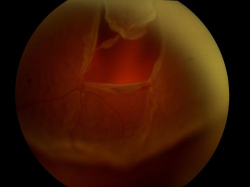 Retinal Detachment Secondary to Irregular Retinal Tear
Retinal Detachment with Irregular Retinal Tear
Keywords: Retinal, Detachment, Tear, Irregular;november2012