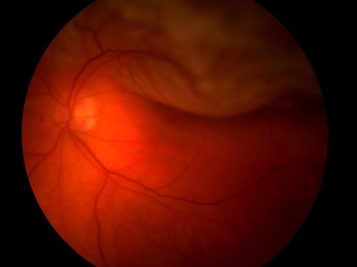 Retinal Detachment
Keywords: retinal, detachment, Macula-off