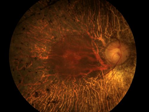 Retinitis Pigmentosa
Retinitis Pigmentosa
Keywords: Retinitis, Pigmentosa, Bone, Spicule