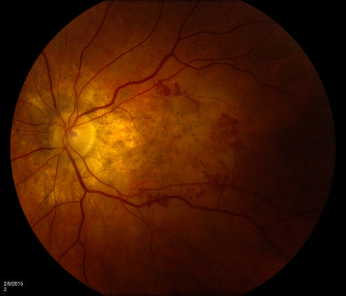 ARMD:  Macular Degeneration with Subretinal Neovascular Membrane
ARMD:  Macular Degeneration with Subretinal Neovascular Membrane. 
Upon presentation, this patient was found to have blots of subretinal hemorrhage extending into her FAZ, secondary to a subretinal neovascular membrane. 

Mots-clés: ARMD;Subretinal;neovascular;neovascularization;membrane;February