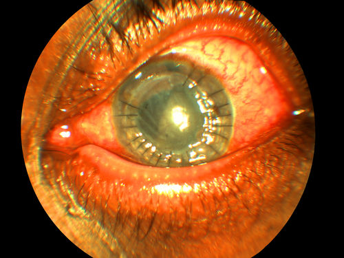 Ocular Trauma with Retinal Detachment
Patient suffered blunt force trauma to the eye resulting total retinal detachment. The retina is visible in the pupillary space.
Mots-clés: Rupture, Retinal, Detachment, Pupillary, Pupil, Corneal, Suture, Blunt, Force, Trauma,may2013