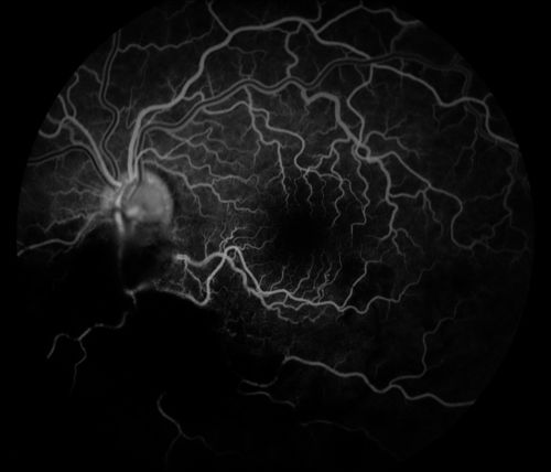 Cytomeglovirus
25 year old male experiencing blurry vision OS for two days.  Onset very rapid.  VA 20/40 OS 20/30 OD.  After HIV titer test, determined the pt. had HIV and Cytomeglovirus.
Keywords: cytomeglovirus, brvo, hiv
