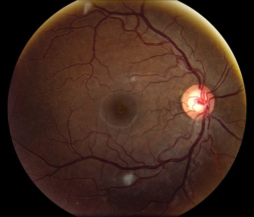 Cytomeglovirus
25 year old male experiencing blurry vision OS for two days.  Onset very rapid.  VA 20/40 OS 20/30 OD.  After HIV titer test, determined the pt. had HIV and Cytomeglovirus.
Keywords: cytomeglovirus, brvo, hiv