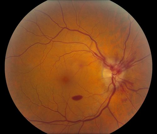 CRVO
58 year old male with present CRVO OU.  Visual Acuity 20/30 OD 20/200 OS.  Pt. recently underwent surgery for cancer of the bladder and has other blood and hemoglobin issues.  Pt sent for further blood work and see a neurologist.  
Keywords: CRVO, hemorrhage