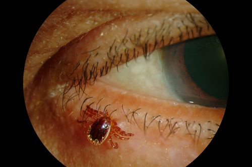 Tick on Lower Lid
Pt. came in for cataract surgery and a tick was found on the lower lid.  Pt. had no idea the tick was attached and did not know how long it had been there.  Tick was photographed and then removed by physician.
Keywords: External, Slit Lamp
