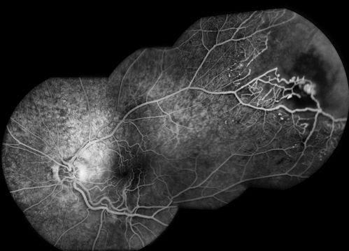 Coats' Disease
11 year old male seen for trauma to OS from a volleyball.  After examination, it was determined the pt had Coat's Disease.  VA 20/20 OD 20/60 OS.  FA confirmed the diagnosis.
Keywords: Coats Disease;june2012