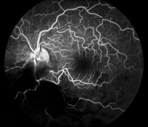 Cytomeglovirus
25 year old male experiencing blurry vision OS for two days.  Onset very rapid.  VA 20/40 OS 20/30 OD.  After HIV titer test, determined the pt. had HIV and Cytomeglovirus.
Keywords: cytomeglovirus, brvo, hiv