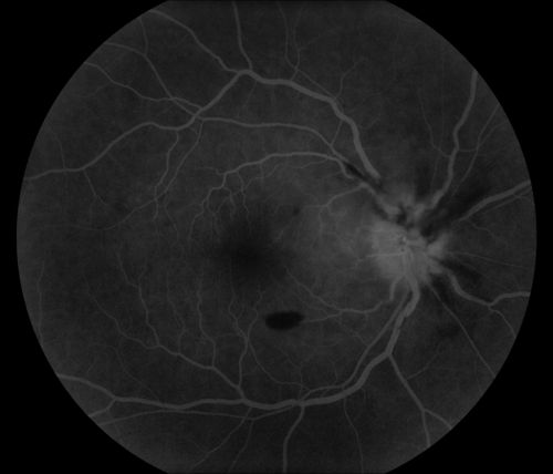 CRVO
58 year old male with present CRVO OU.  Visual Acuity 20/30 OD 20/200 OS.  Pt. recently underwent surgery for cancer of the bladder and has other blood and hemoglobin issues.  Pt sent for further blood work and see a neurologist.  
Keywords: CRVO, hemorrhage