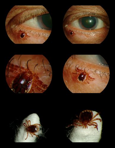Tick on Lower Lid
Pt. came in for cataract surgery and a tick was found on the lower lid.  Pt. had no idea the tick was attached and did not know how long it had been there.  Tick was photographed and then removed by physician.
Keywords: External, Slit Lamp